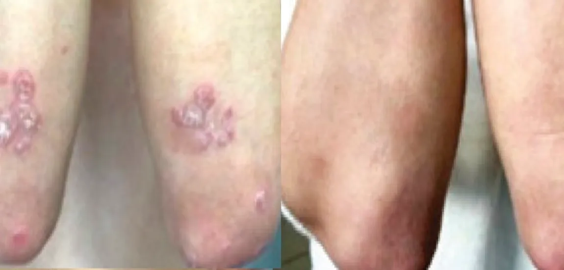 For millions of people living with psoriasis, the condition has long been defined by its stubborn nature and the frustrating reality that no permanent cure e...